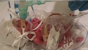 Los médicos salvan a un bebé prematuro envolviéndole en una bolsa.
