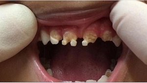 Un dentista tuvo que quitar a un niño 11 muelas. ¡La razón fue increíble!